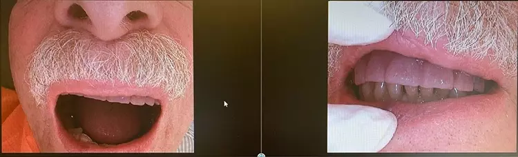 Abb. 10 a und b: Ein Bild sagt mehr als tausend Worte. Einprobe der Duplikatprothese. Die Mundfotos gaben Aufschluss über die notwendigen Änderungen.