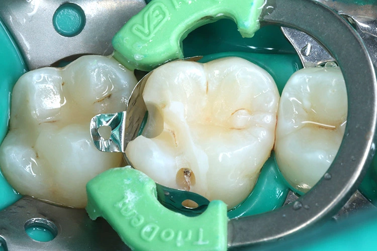 Abb. 9: Okklusale Ansicht der Kavität nach Konditionierung mit Phosphorsäure.