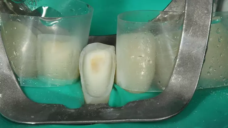 Abb. 11: Vorbehandlung der Klebefläche des Zahnes 41 zur adhäsiven
Befestigung des Veneers (nach Abstrahlen mit 50 μm Al2O3).