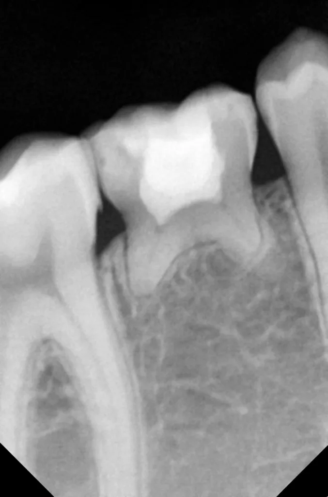 Röntgenbild des Zahnes 85; 6 Jahre nach der Behandlung.