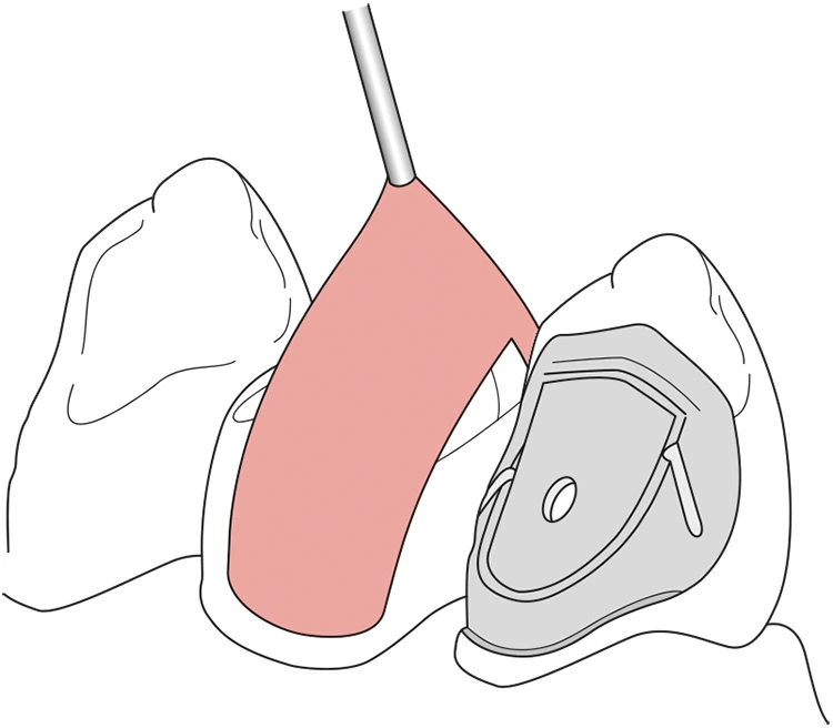 Abb. 11: Merkmale der empfohlenen Adhäsivpräparation bei Frontzähnen mit
Orientierungspin [17].