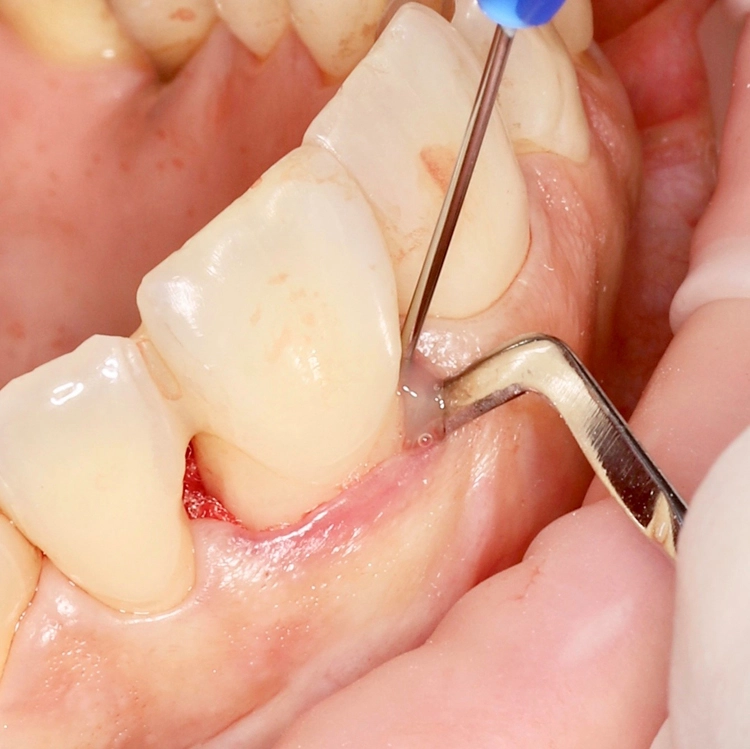 Abb. 11: Einbringen von Straumann Emdogain® FL mesial, Superfloss dient distal zur Wahrung der Distanz in situ.