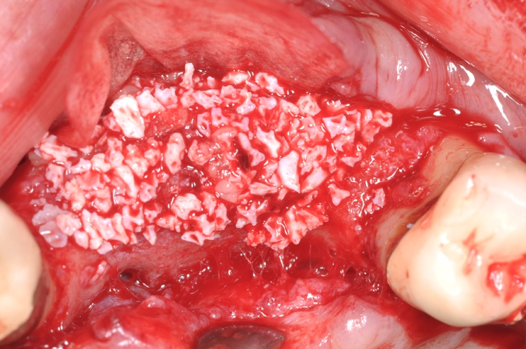 Abb. 11: Augmentatives Relining als Resorptionsschutz und zur Konturaugmentation in der ästhetischen Zone mit bovinem Knochenersatzmaterial und nativer Kollagenmembran (XenoGraft, Jason® membrane, Straumann).