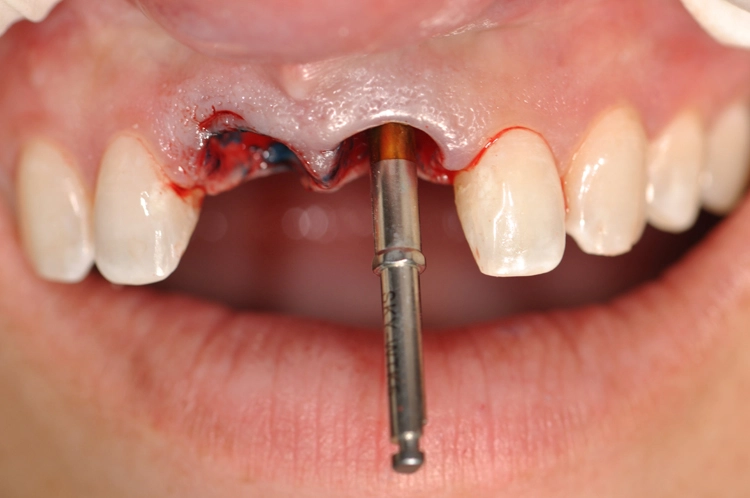 Abb. 12: Kontrolle der Implantatachse.