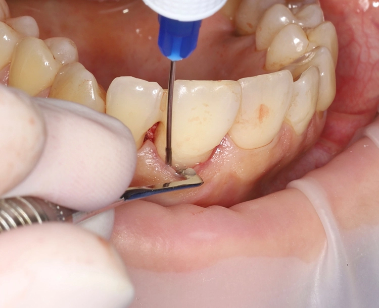 Abb. 12: Einbringen von Straumann Emdogain® FL in den blutungsfreien Sulcus.