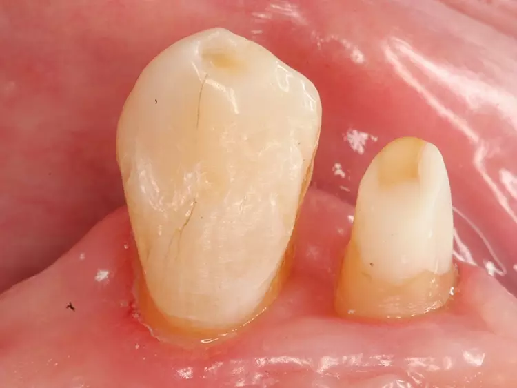 Abb. 12: Fertige Präparation für einen metallischen Adhäsivflügel.