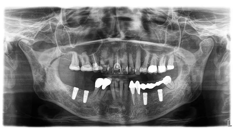 Abb. 12: Röntgenkontrollaufnahmen nach Implantation und zweimonatiger gedeckter Einheilzeit (im III. Quadranten wiederum unter dem LZP).