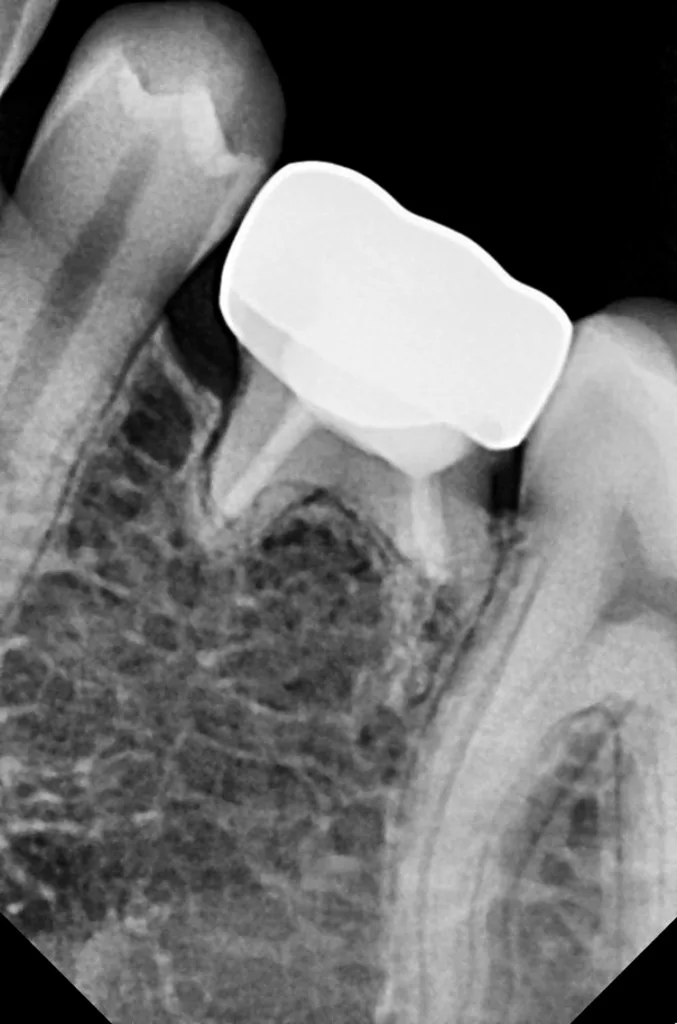 Abb. 12: des Zahnes 75; 6 Jahre nach der Behandlung.