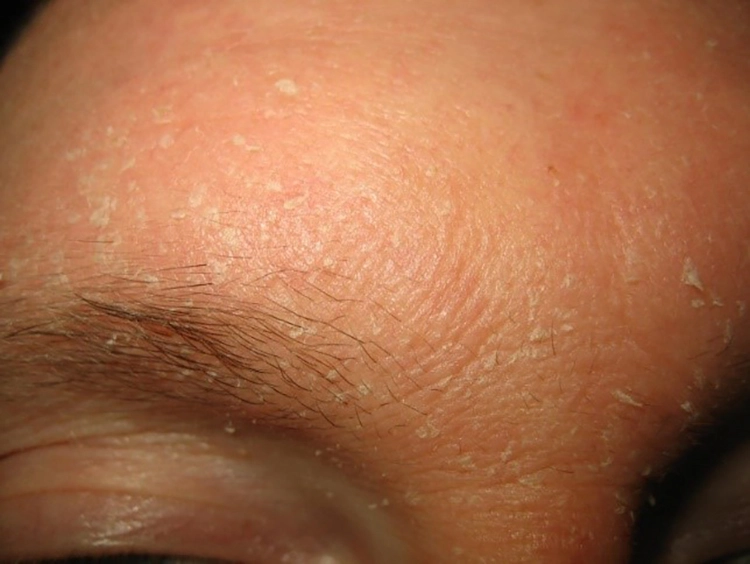 Abb. 12: Seborrhoische Dermatitis an Stirn und Nasenwurzel. Charakteristisch sind Schuppung und Rötung.