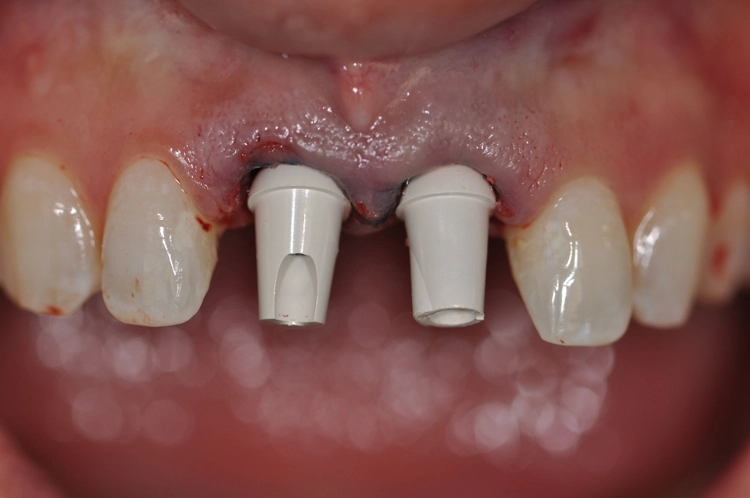 Abb. 13: Individualisierte BioHPP SKY elegance Abutments von frontal und palatinal.