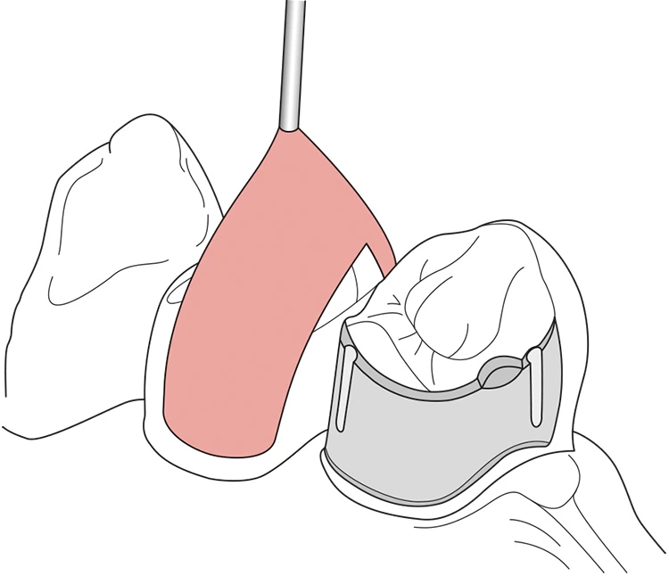 Abb. 13: Merkmale der empfohlenen Adhäsivpräparation bei Seitenzähnen mit Orientierungspin [17].