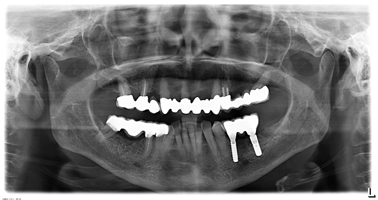 Abb. 14. OPG mit inserierten Implantaten im UK links vom 16.12.2014.