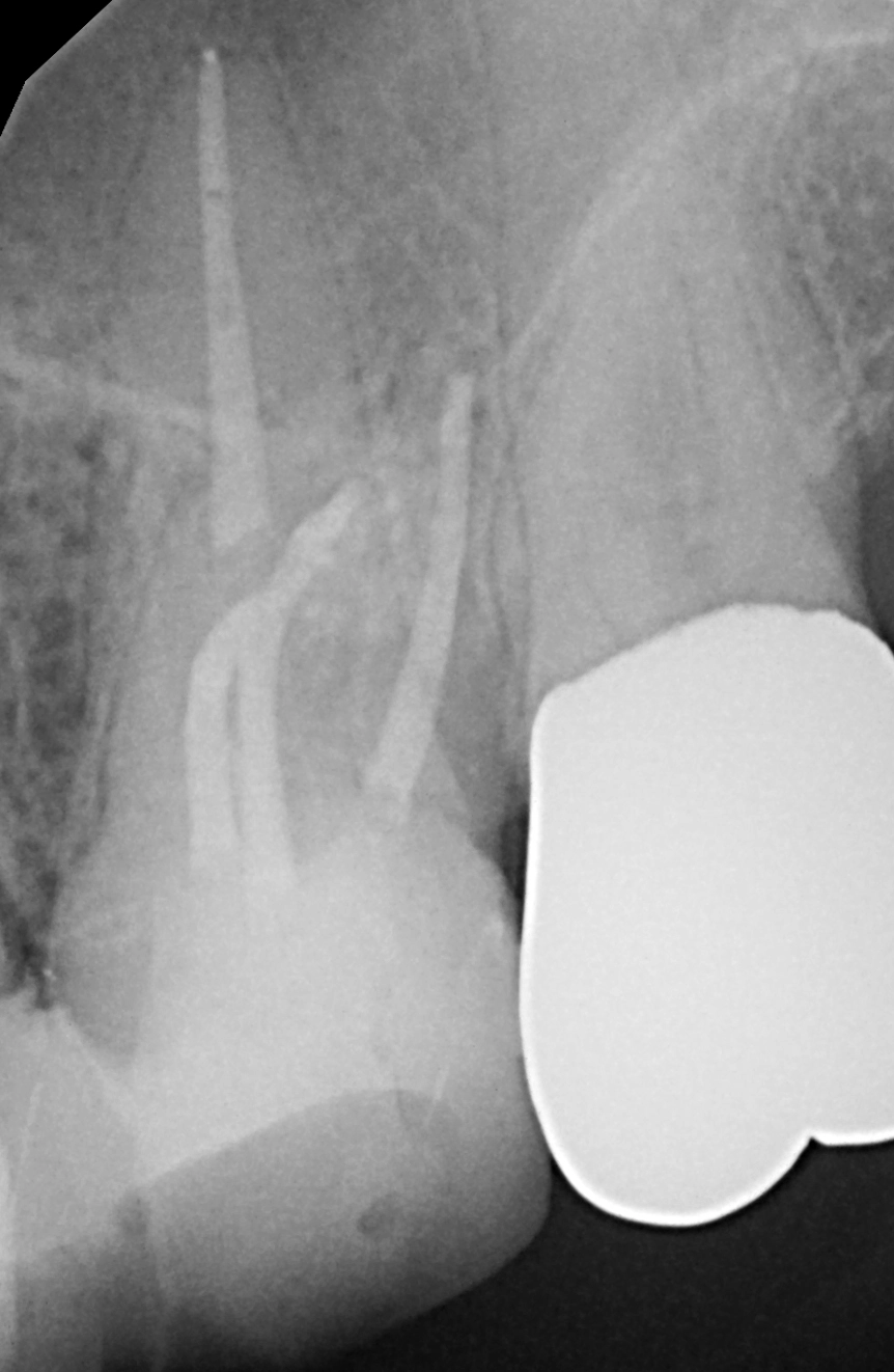 Abb. 60: Röntgenkontrolle der Wurzelkanalfüllung und des blasenfrei applizierten Stumpfaufbaus an Zahn 26.