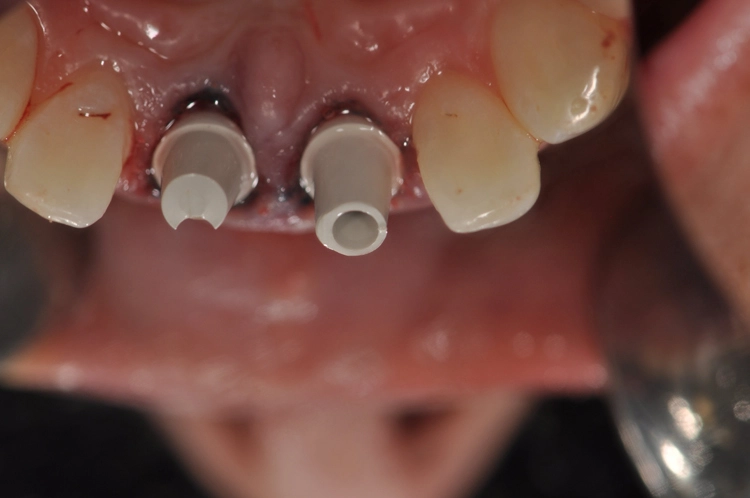 Abb. 14: Individualisierte BioHPP SKY elegance Abutments von frontal und palatinal.