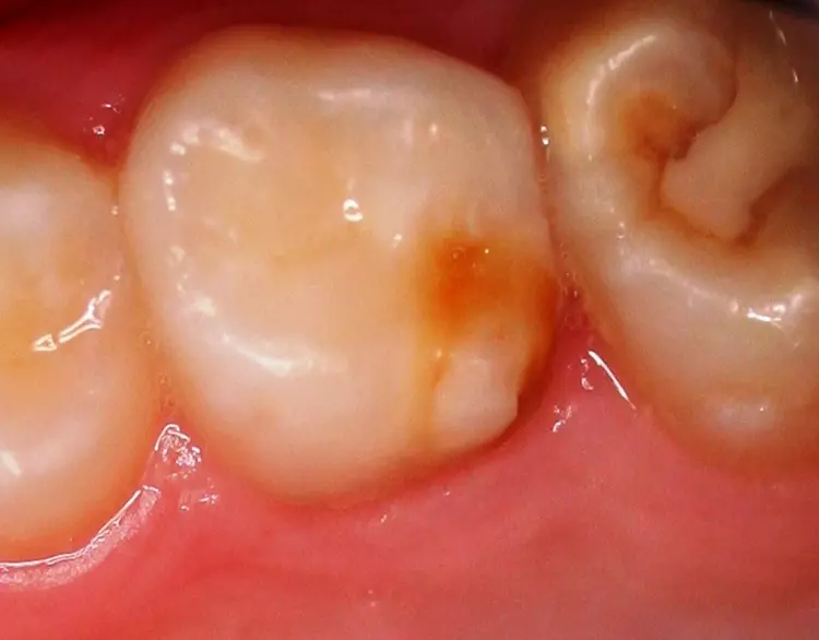 Abb. 14: Hypomineralisation am zweiten Milchmolaren (MMH) im Oberkiefer,
zugleich liegt an 26 eine MIH vor. Das Risiko von MIH ist bei MMH erhöht.