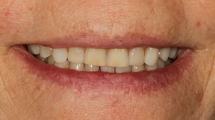 Abb. 14: Lippenbild bei der 1-Jahres-Kontrolle.