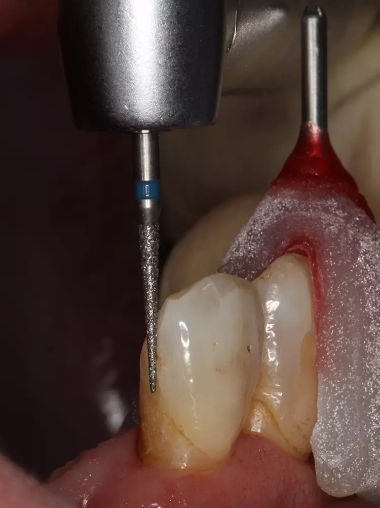 Abb. 14: Orientierungspin zur visuellen Kontrolle
der Rillenpräparation.