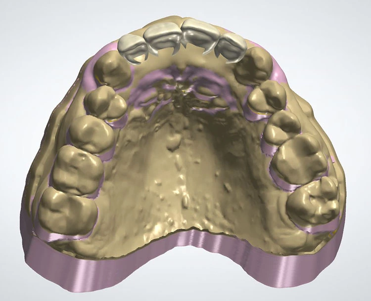 Abb. 14: Im nächsten Schritt konstruiert man die zu ersetzenden Zähne mit einem gleichmäßigen Abstand zur Gingiva. Es empfiehlt sich dabei, ausreichend Platz basal einzuplanen, falls hier später ausgeschliffen werden muss.