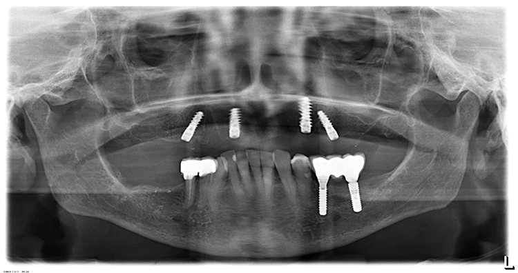 Abb. 15: Postoperatives OPG nach Implantat-Insertion im OK vom 2.12.2019.