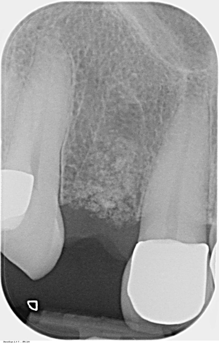 Abb. 11: Radiologische Nachkontrolle und Überprüfung der Augmentation bei nahezu strukturidentischer Verteilung des KEM in der Extraktionsalveole.