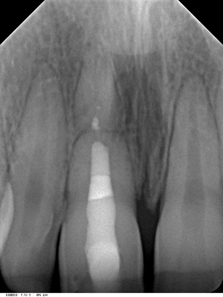 Abb. 15: Recall nach 3 Jahren während der kieferorthopädischen Behandlung des Patienten: Man erkennt eine Abrundung der Wurzel im Bereich des Bruchspalts sowie ein leichtes Auseinanderdriften der beiden Fragmente sowohl als Folge des Kieferwachstums als auch der kieferorthopädischen Therapie.
