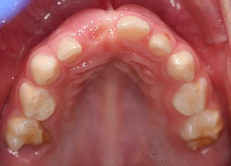 Abb. 15: MMH an beiden oberen zweiten Milchmolaren mit großen Substanzdefekten.
Das Risiko einer pulpalen Beteiligung ist v.a. bei Zahn 55 vorhanden.