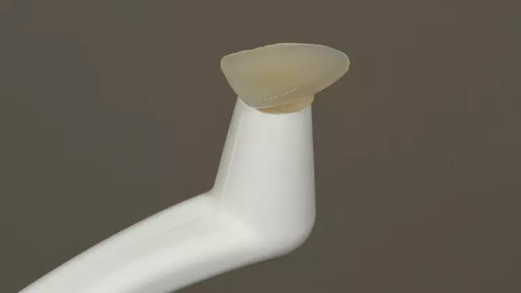 Abb. 15: Veneer 42 vorbereitet zur adhäsiven Befestigung.