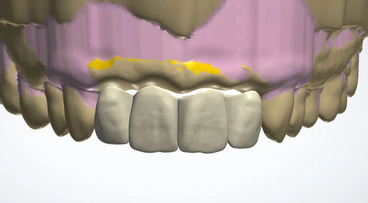 Abb. 15: Im nächsten Schritt konstruiert man die zu ersetzenden Zähne mit einem gleichmäßigen Abstand zur Gingiva. Es empfiehlt sich dabei, ausreichend Platz basal einzuplanen, falls hier später ausgeschliffen werden muss.