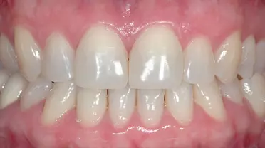 Abb. 16: Klinische Situation 3 Monate nach Füllungstherapie, reizlose gingivale Verhältnisse, leichte Plaqueakkumulation zwischen 11 und 21, es erfolgte eine Re-Instruktion der Patientin in Bezug auf die Interdentalraumreinigung.