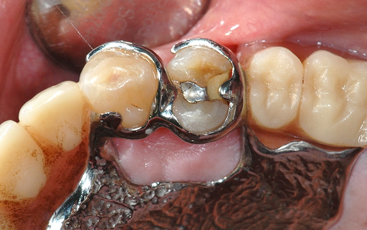 Abb. 17: Oberkiefer-Modellguss mit Halteelementen an Zahn 23 und 24, der Zahn 24 besitzt eine insuffiziente Restauration aus Amalgam und einem provisorischen Zement, die Passung der Klammerauflage distal am Zahn 24 ist unzureichend.