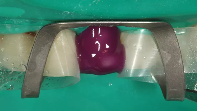 Abb. 16: Das adhäsive Einsetzprocedere des
Veneers 21.