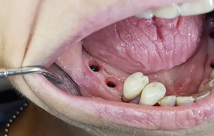 Abb. 16: Finale Versorgung mit verblockten Implantatkronen in regio 45 und 46 in stabil ausgeformter periimplantärer Weichgewebemanschette.
