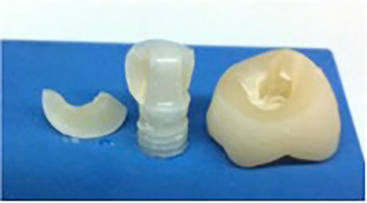 Abb. 17: Kronenfraktur nach Abzugsversuch. Die Krone wurde mit Panavia F 2.0 (Kuraray Noritake Dental) auf dem Abutment befestigt.