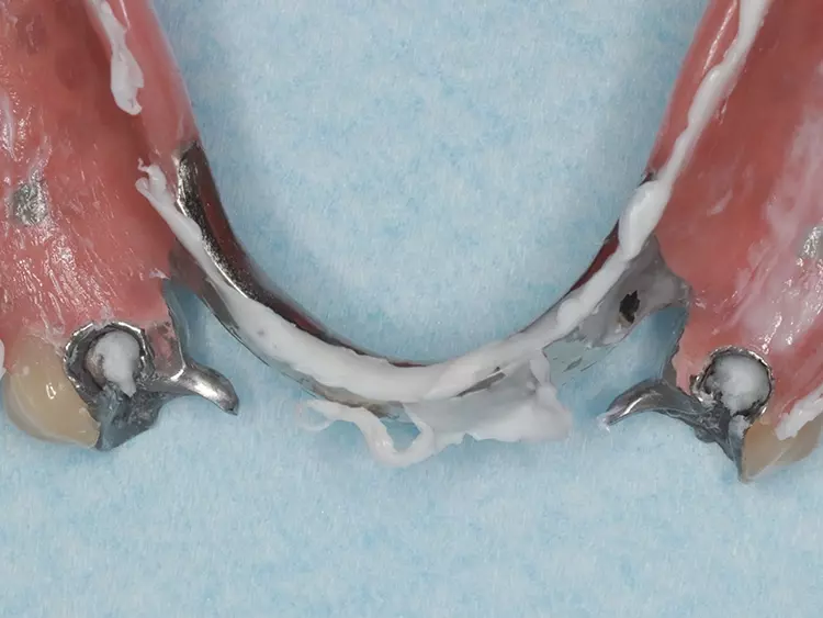 Abb. 17: Fließsilikonprobe der Prothesenbasis.