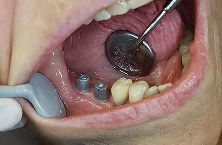 Abb. 17: Finale Versorgung mit verblockten Implantatkronen in regio 45 und 46 in stabil ausgeformter periimplantärer Weichgewebemanschette.