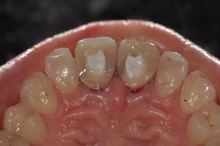 Abb. 18: Palatinale Ansicht mit den intraoral individualisierten Abutments.