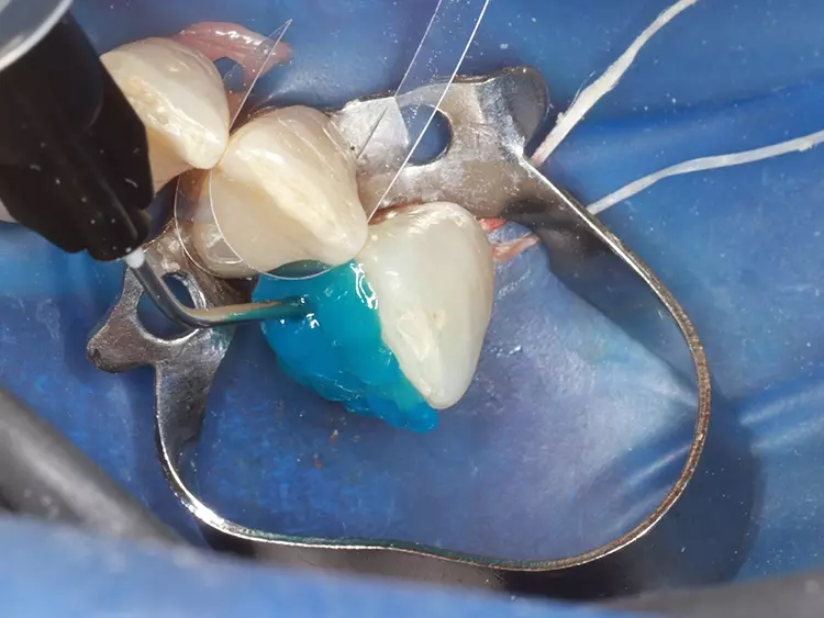 Abb. 18: Anätzen der Klebefläche mit 37%iger
Phosphorsäure.