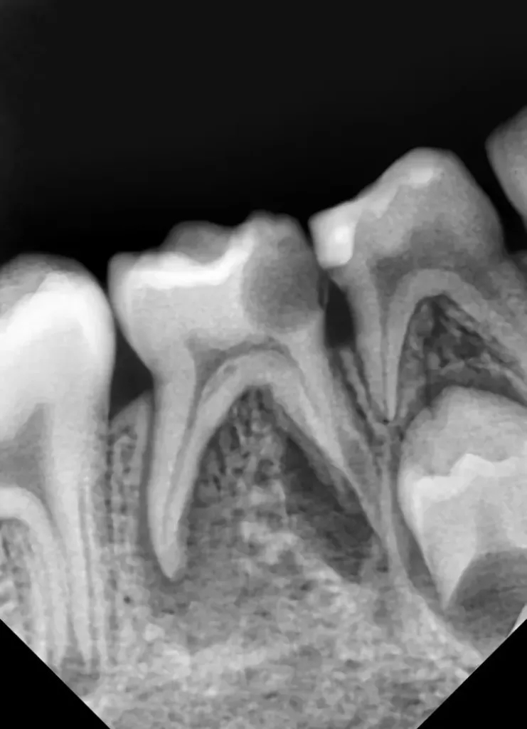 Abb. 18: Ausgangsröntgenbild des
Zahnes 85.