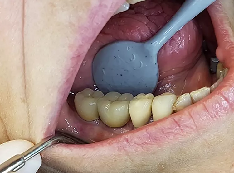 Abb. 18: Finale Versorgung mit verblockten Implantatkronen in regio 45 und 46 in stabil ausgeformter periimplantärer Weichgewebemanschette.