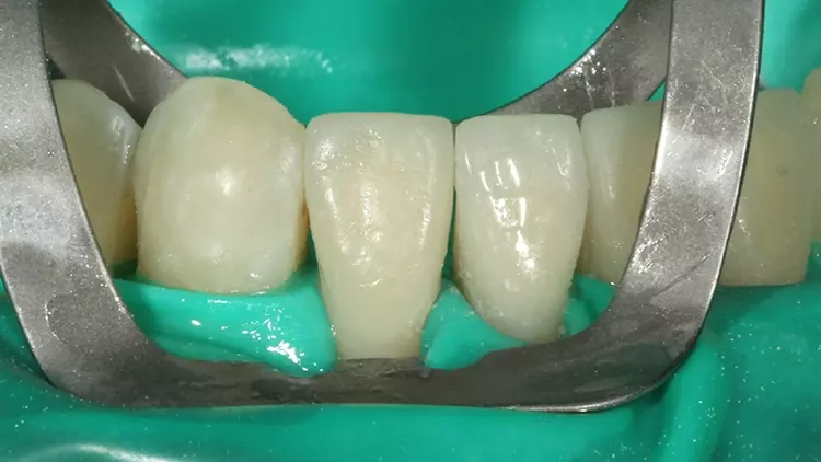 Abb. 18: Das verklebte Veneer 42 unmittelbar vor Abnahme des Kofferdams.