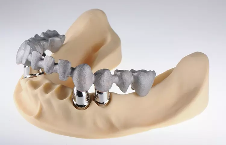 Abb. 14: Demonstration eines Metallgerüstes für eine Teleskopversorgung im Unterkiefer aus 2 verschiedenen Metallen, zusammen hergestellt in einem Bauprozess
mittels Metall-Multimaterial-3D-Druck.