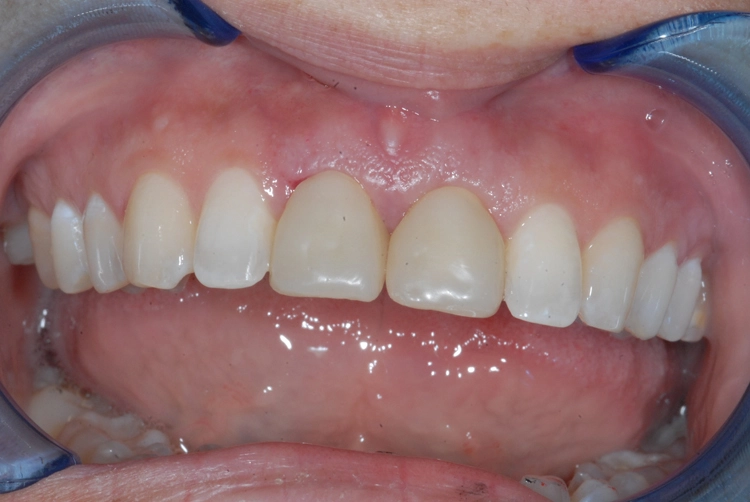 Abb. 19: Unmittelbar nach Implantation chairside hergestelltes Provisorium in situ.