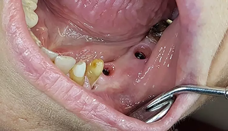 Abb. 19: Finale Versorgung mit Einzelkronen auf Zahn 33 und 34 sowie einer Implantatbrücke von 35 bis 37 in stabil ausgeformter periimplantärer Weichgewebemanschette.