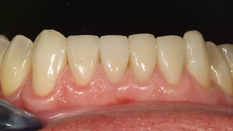 Abb. 19: Die verklebten Unterkiefer-Veneers bei einer Kontrolle nach 2 Wochen.