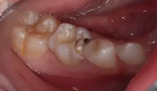 Das intraorale klinische Bild zeigt den ausgeprägten Defekt mesial an Zahn 85.