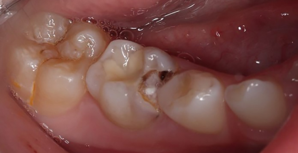 Abb. 19: Das intraorale klinische Bild zeigt den ausgeprägten Defekt mesial an
Zahn 85.
