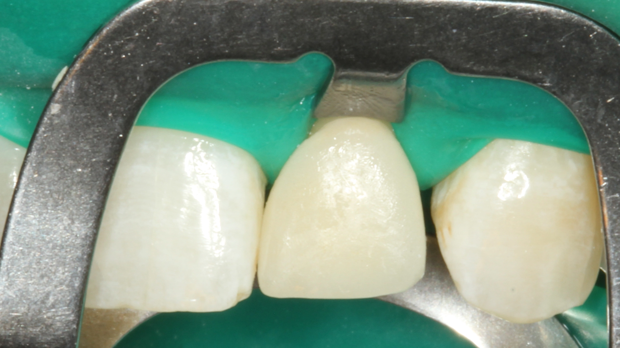 Abb. 26: Die versäuberte, eingeklebte verblendete Vollzirkonkrone noch unter Kofferdam.