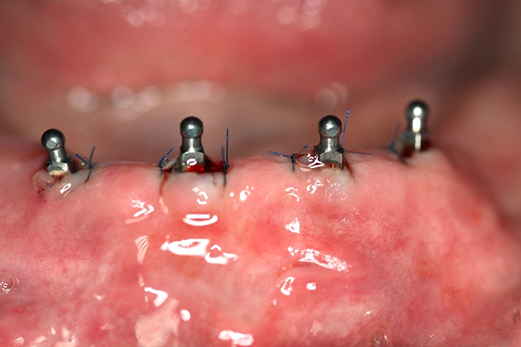 Abb. 1: MDI-Implantate nach Insertion im UK.