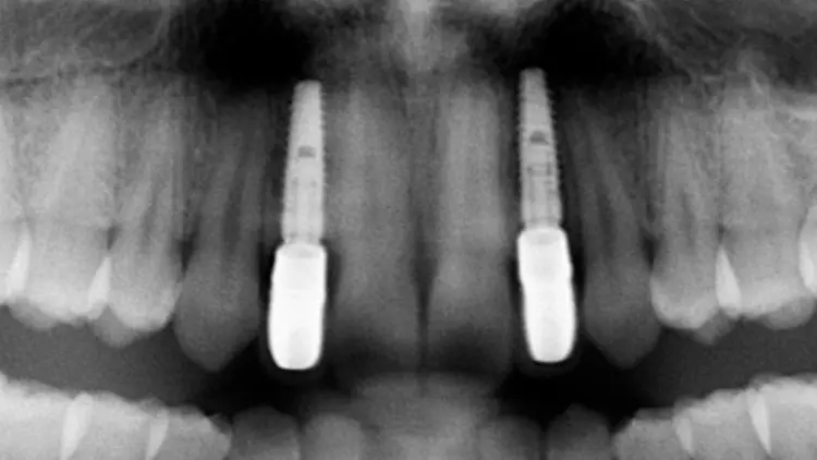 Abb. 1: Implantatprothetische Versorgung von Nichtanlagen der Zähne 12, 22.