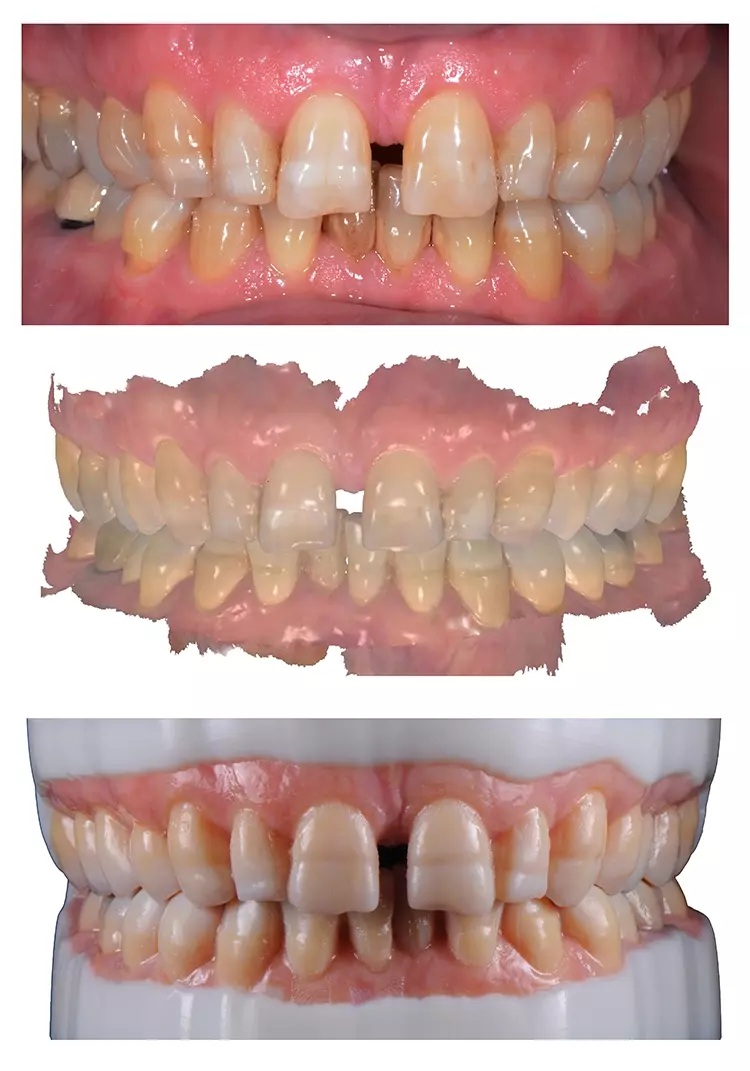 Abb. 1: Intraoraler 3D-Farbscan, dazugehöriger Scandatensatz und mittels Multimaterial-
3D-Druck (Stratasys) hergestellte Vollfarben-3D-Modelle (von oben nach
unten).
